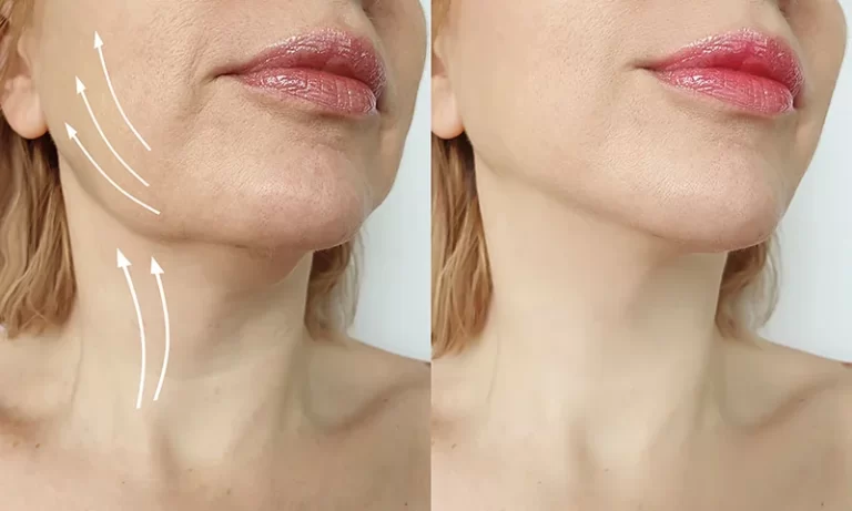 before and after side by side photo of woman's neck and face