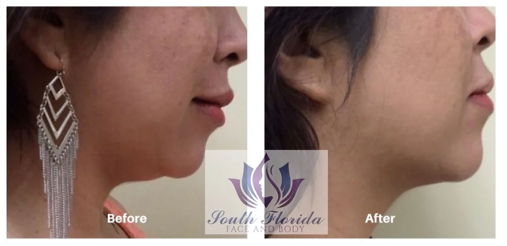 kybella_1681993594