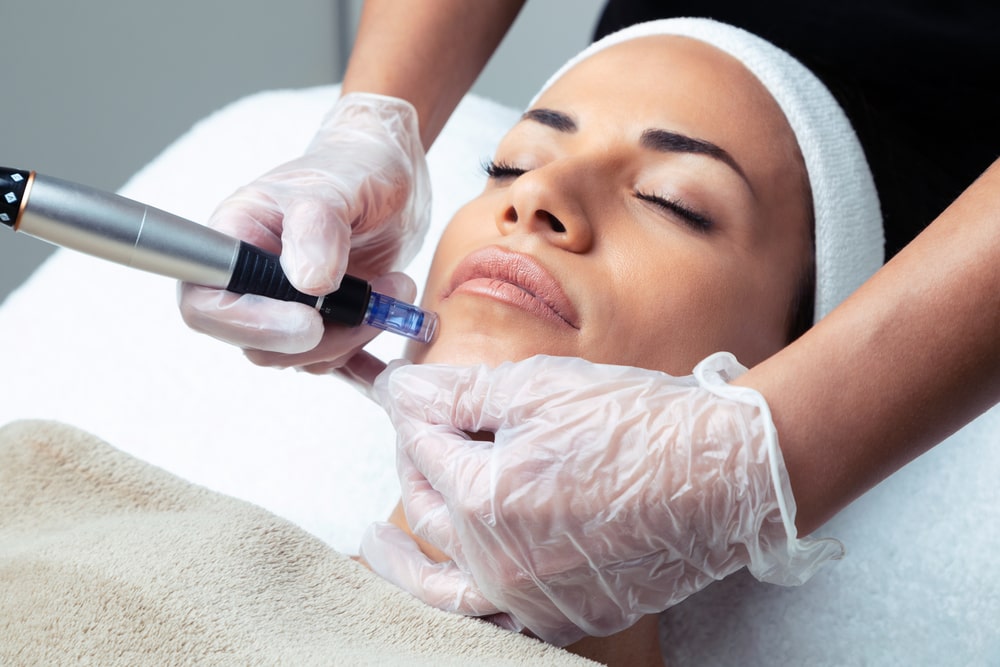 Woman getting microneedling by medical aesthetician.