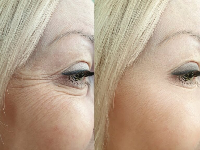 woman with close of crows feet on left and no wrinkles on the right after treatment.