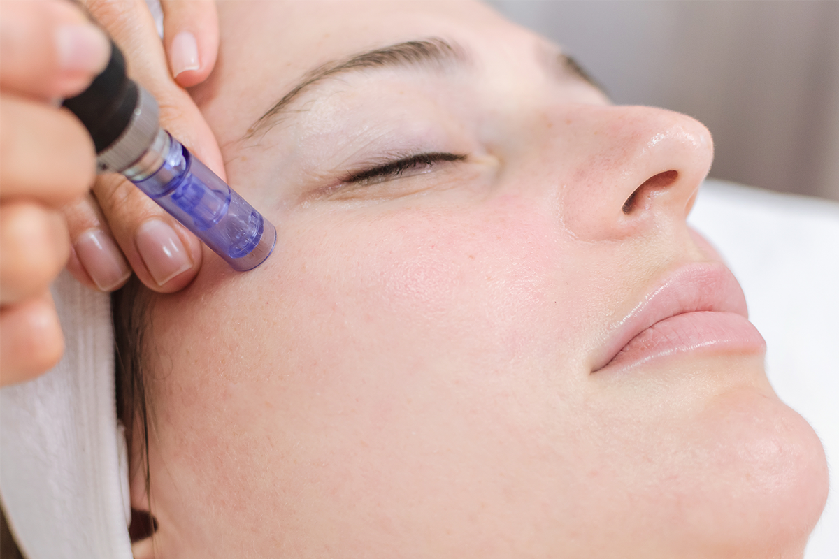 What Is Microneedling with Exosomes? Everything You Need to Know