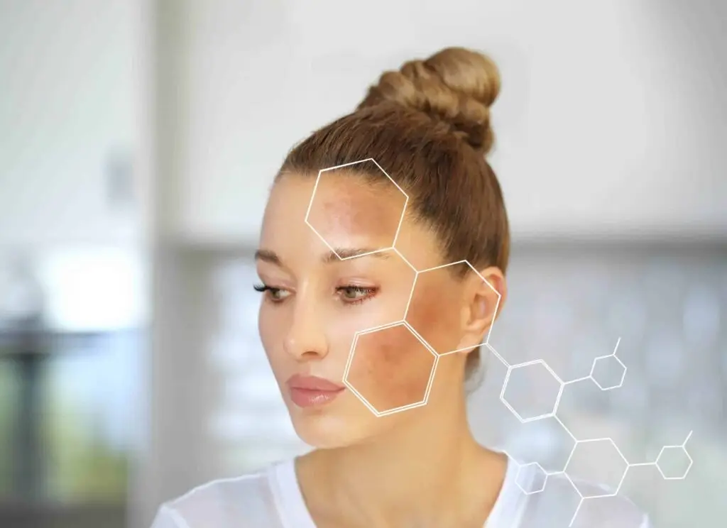 Hyperpigmentation by Willow Medspa and Salon in Morgantown WV scaled 1 1024x744 1