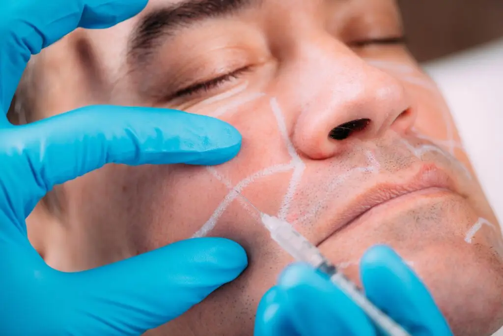 dermal filler men injection mapping miami beach