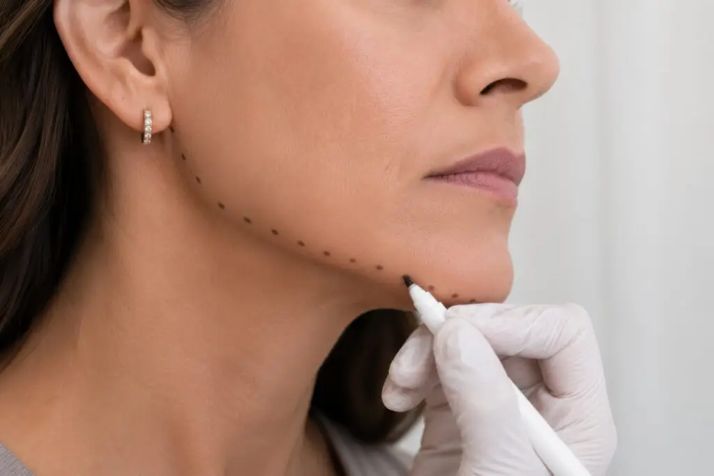 jawline filler treatment mapping miami beach