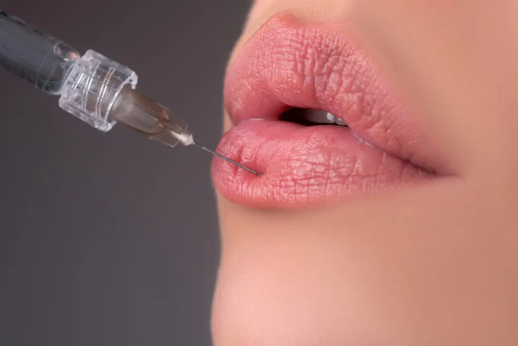 lip augmentation closeup miami beach
