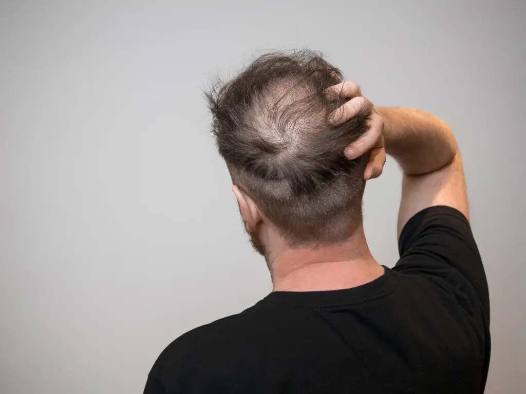 male pattern hair loss crown miami beach
