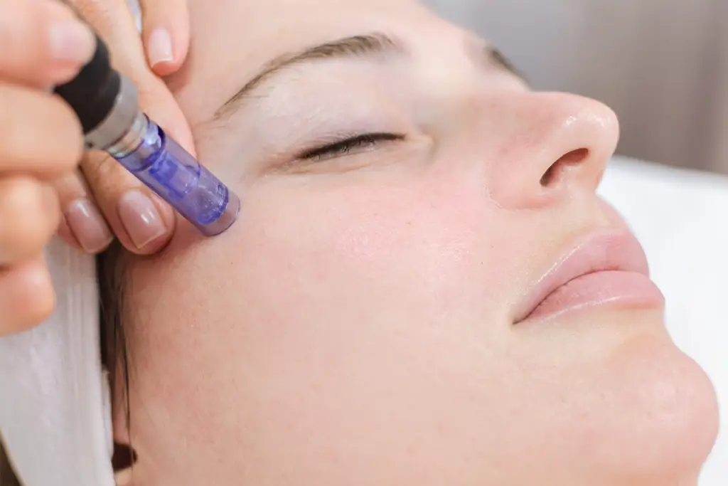 microneedling 1 1024x683
