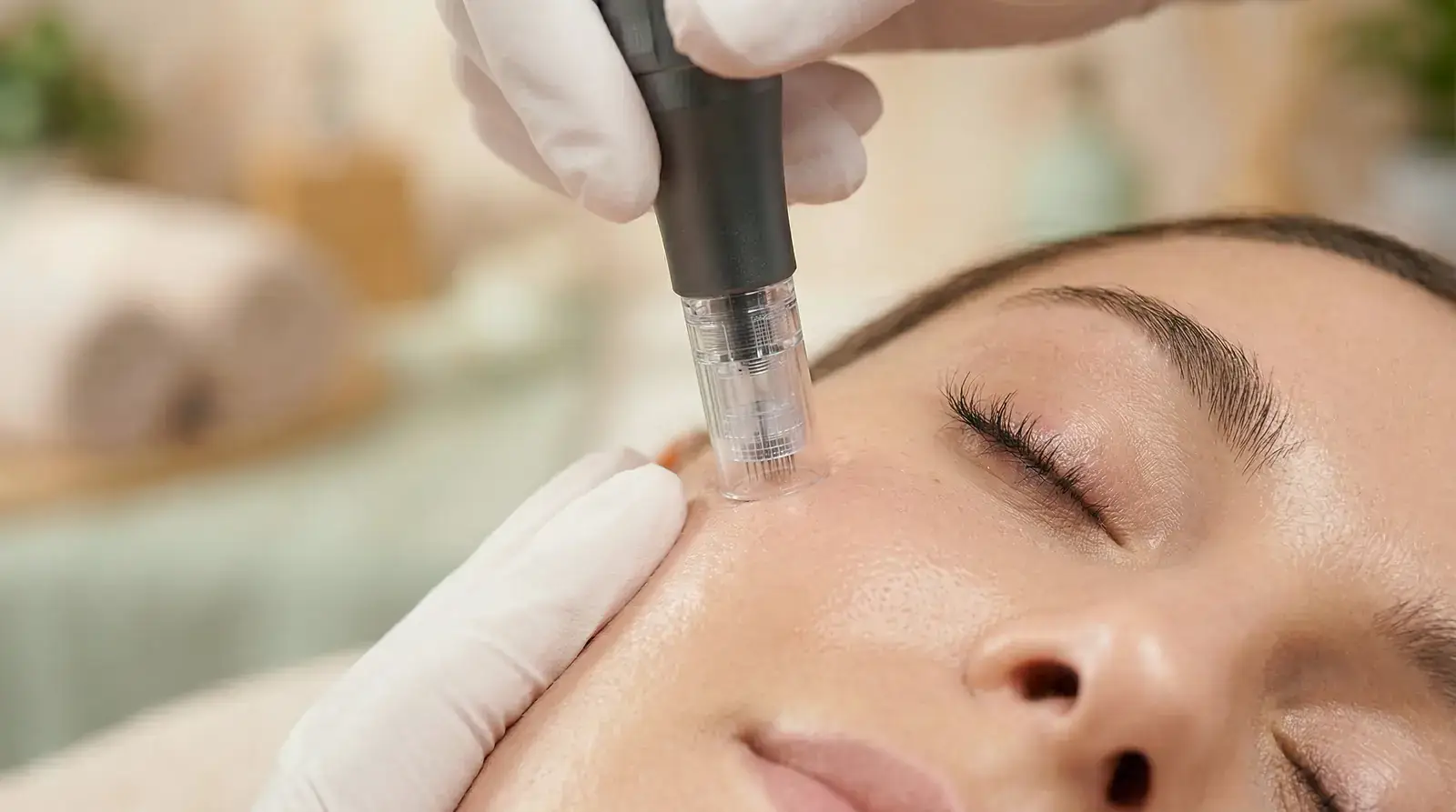 Microneedling for acne scars in Miami Beach - collagen-induction pen treating the skin