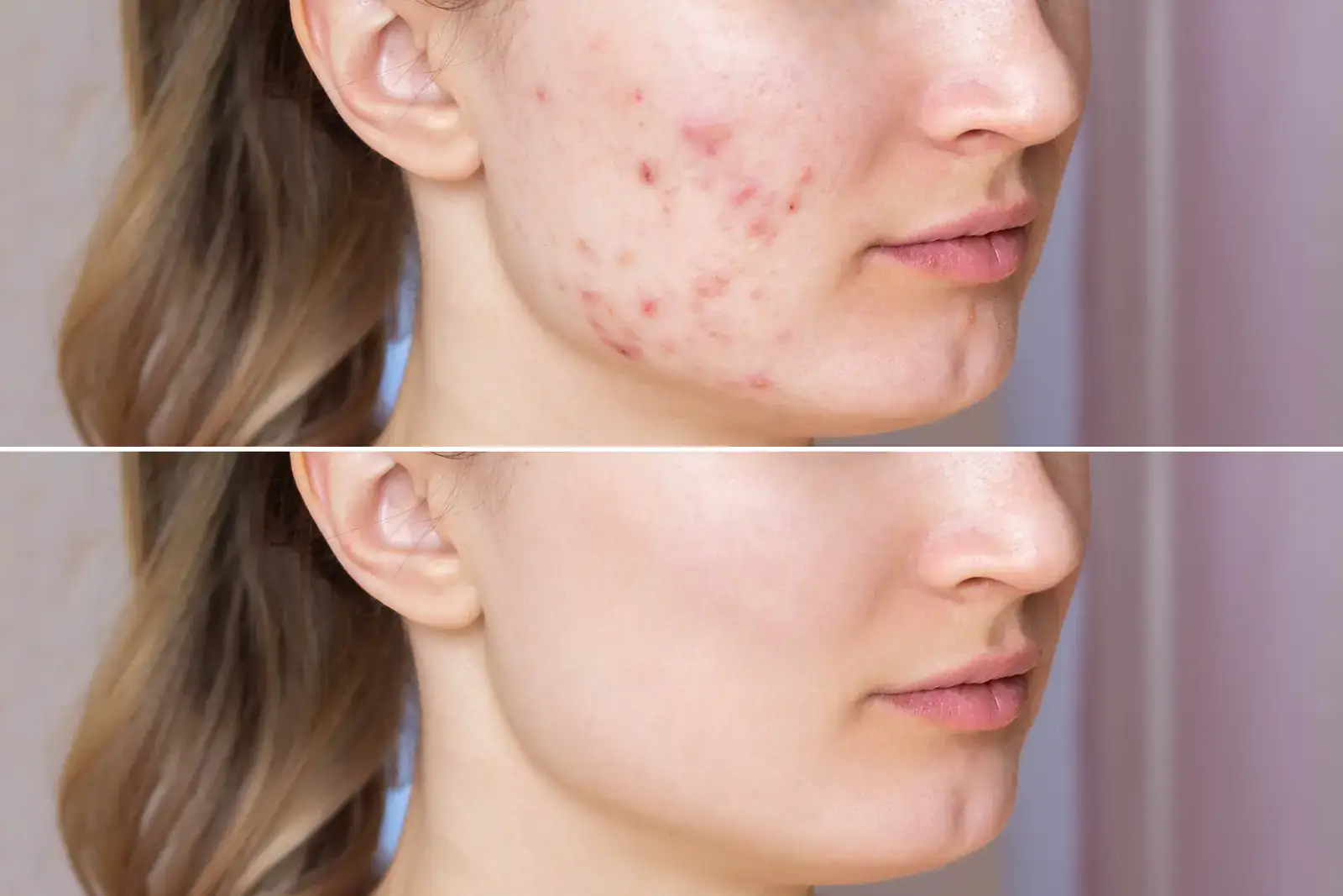 Acne and post-acne marks before and after treatment in Miami Beach