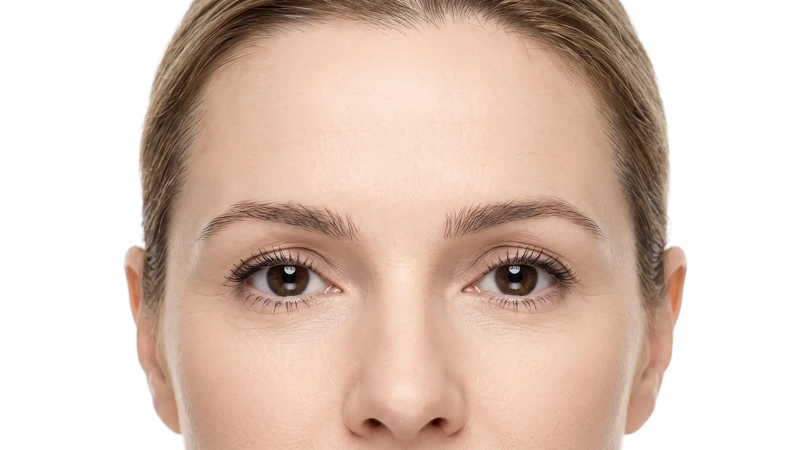 Smooth forehead with natural brow movement after Botox for forehead lines in Miami Beach