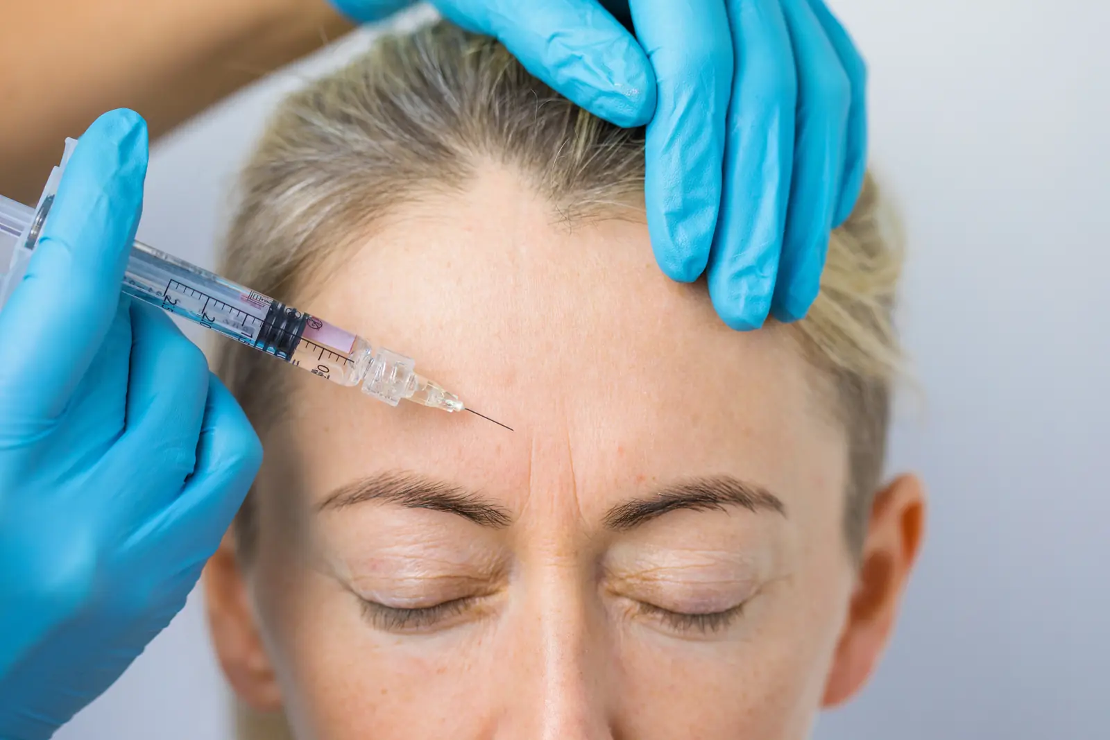 Forehead lines treatment in Miami Beach — nurse practitioner injecting the frontalis muscle across the forehead