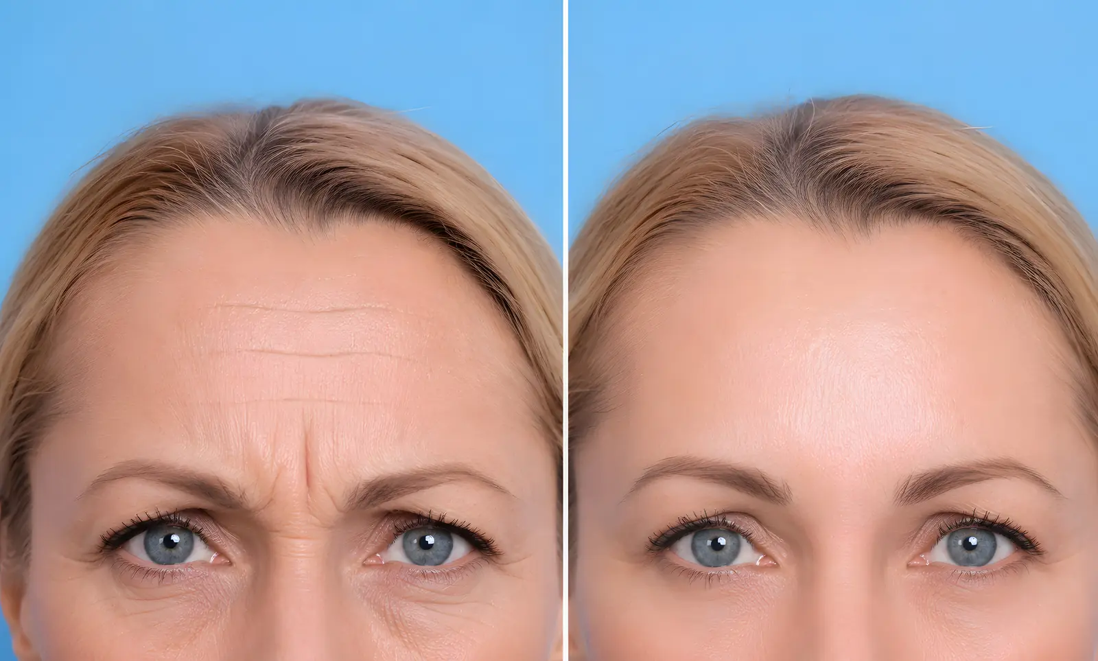 Frown lines (the 11s) before and after neuromodulator treatment in Miami Beach