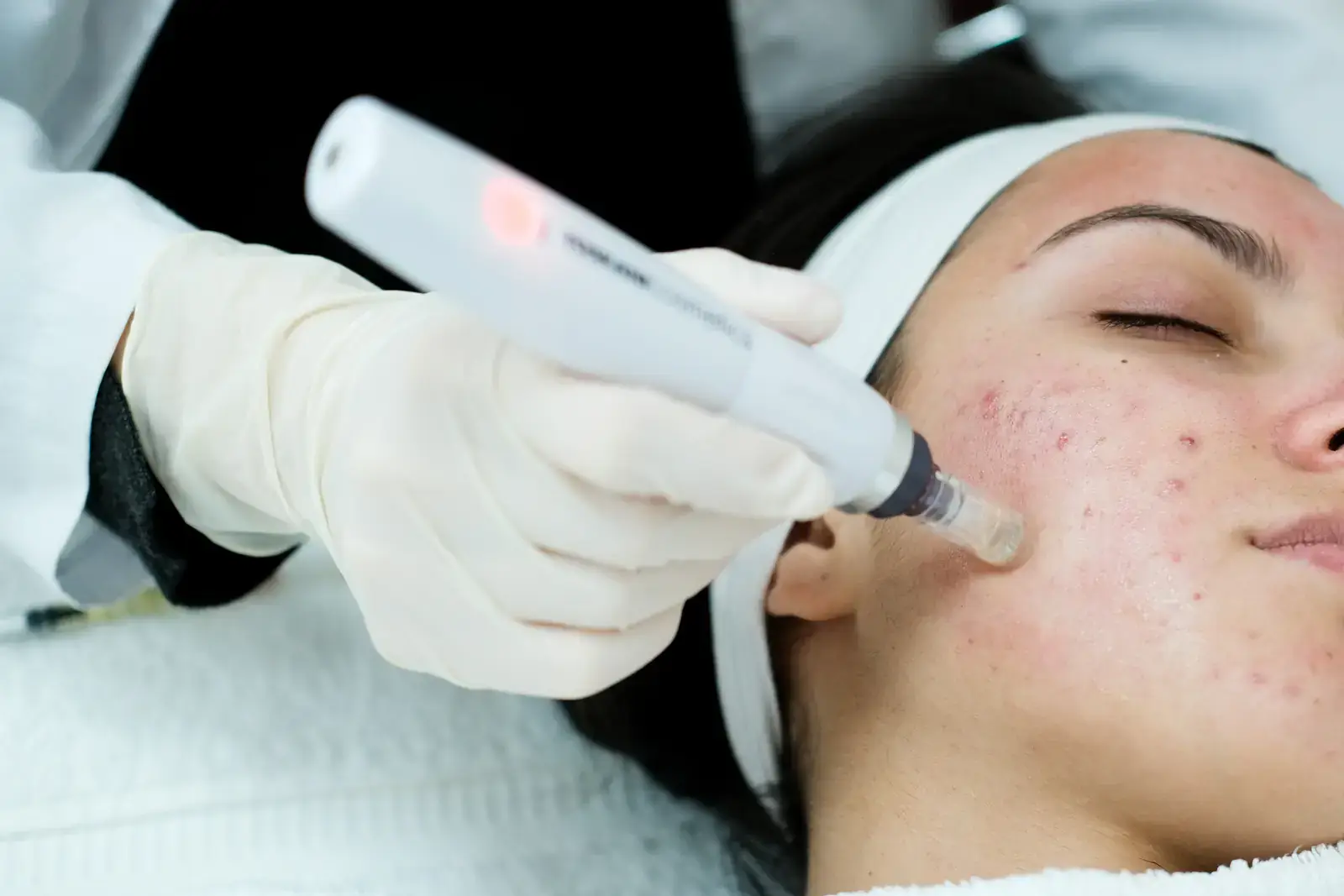 Medical microneedling for acne scars in Miami Beach - collagen-induction pen treating acne-prone skin