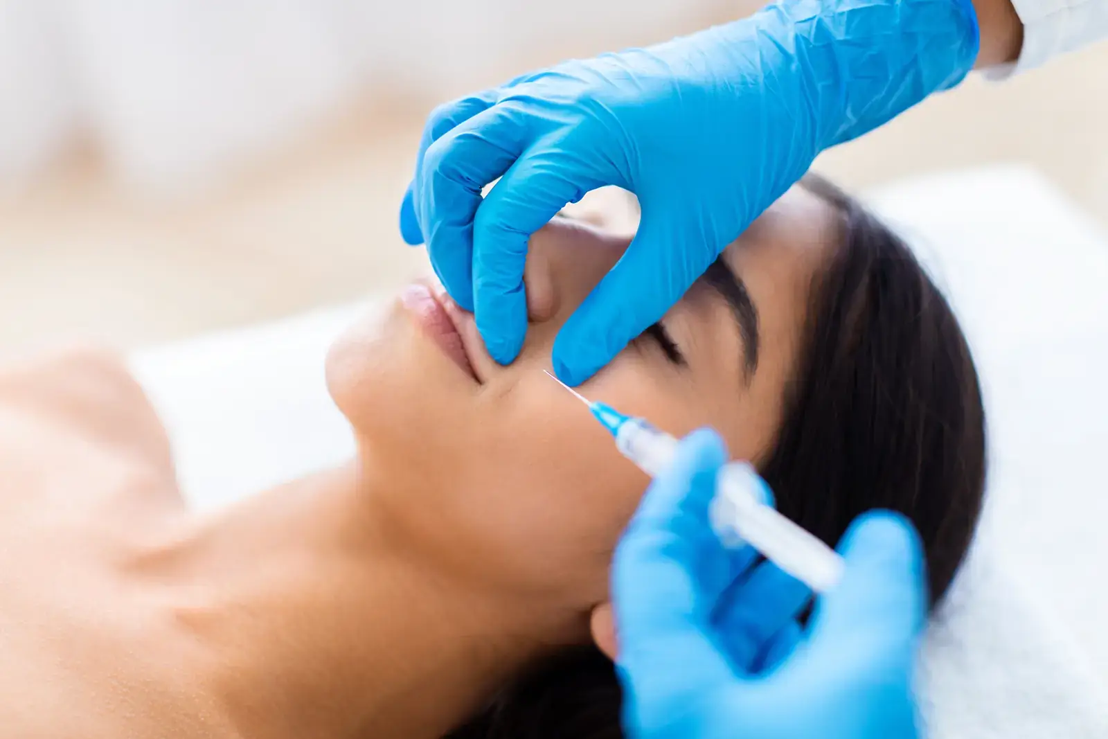 Nasolabial fold filler in Miami Beach - hyaluronic-acid filler placed conservatively to soften the smile line