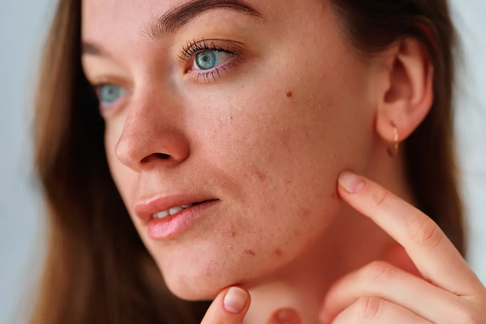 Close-up of acne scars and post-acne marks on the cheek - acne scar treatment in Miami Beach