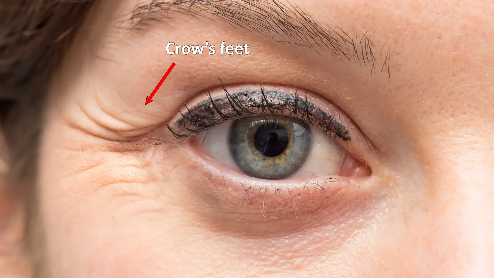 Close-up of crow's feet at the outer corner of the eye, labeled — crow's feet treatment in Miami Beach