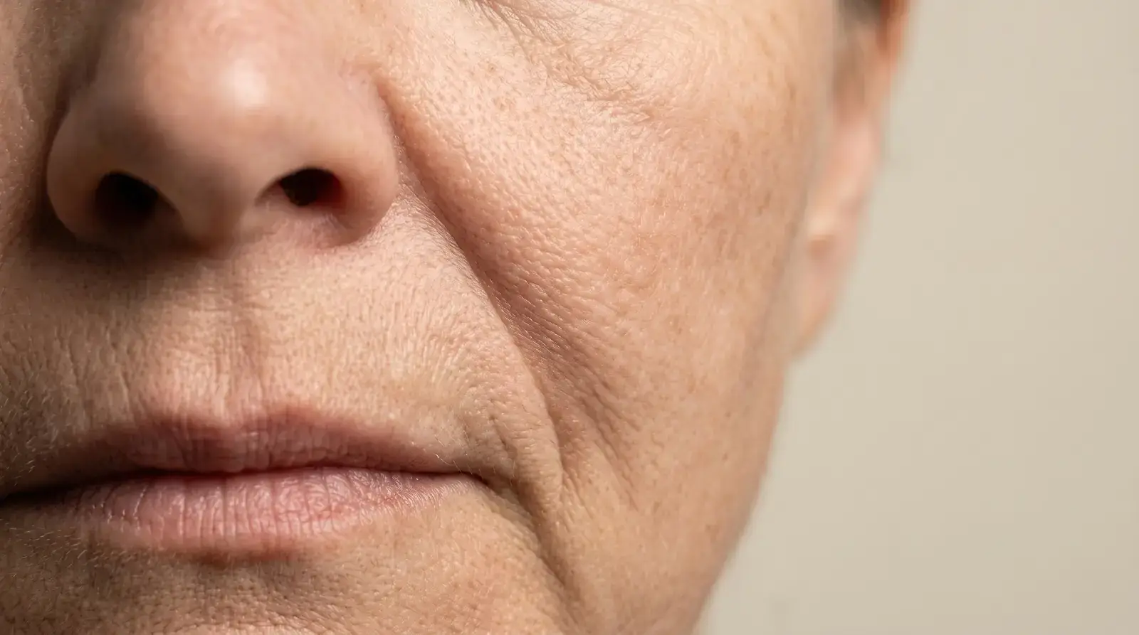 Close-up of a nasolabial fold (smile line) running from the nose to the mouth - nasolabial fold treatment in Miami Beach