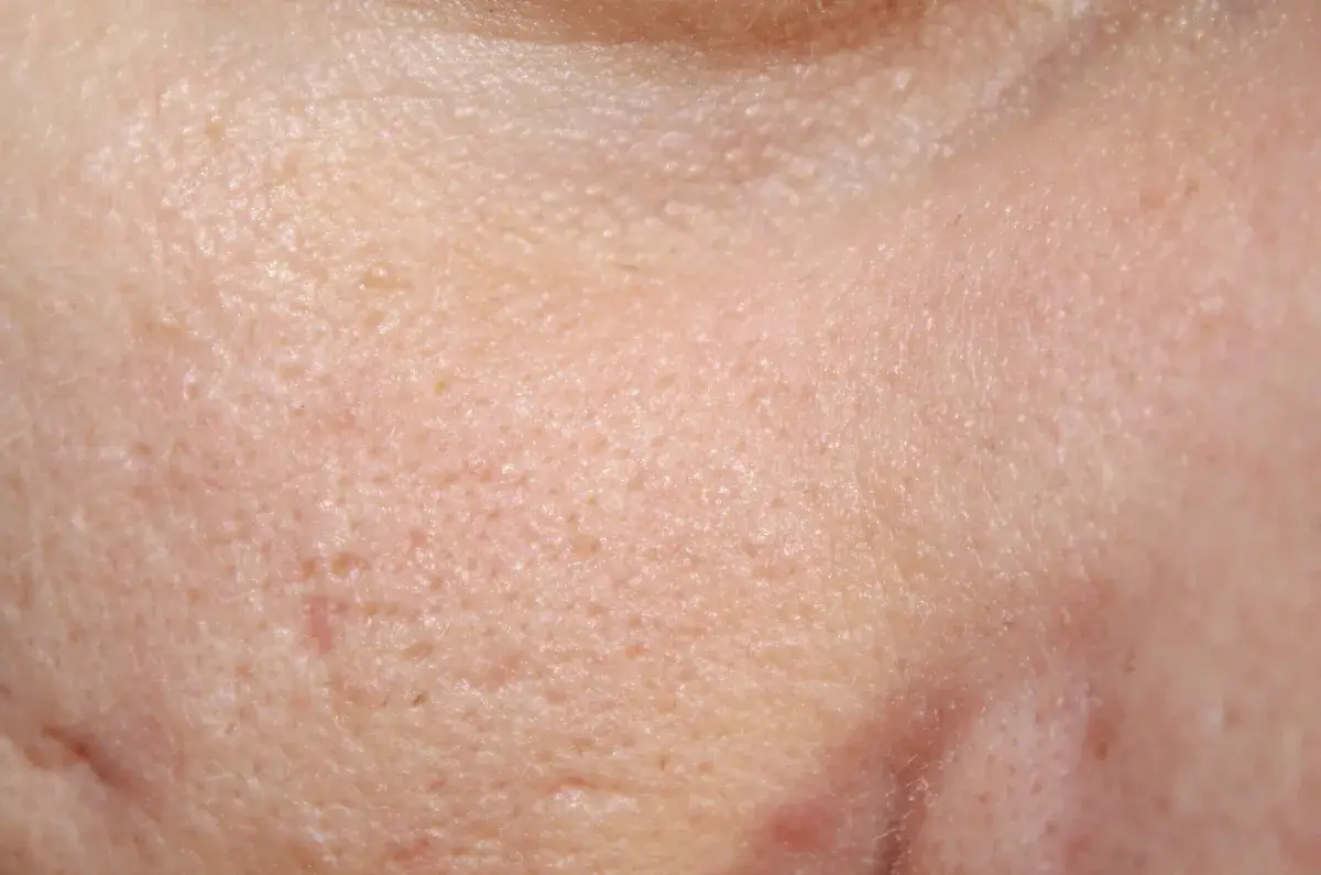 Close-up of atrophic acne scar texture on a cheek, treated with microneedling in Miami Beach