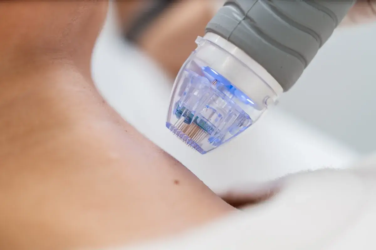 Microneedling treatment to soften crow's feet at a Miami Beach medspa in South of Fifth