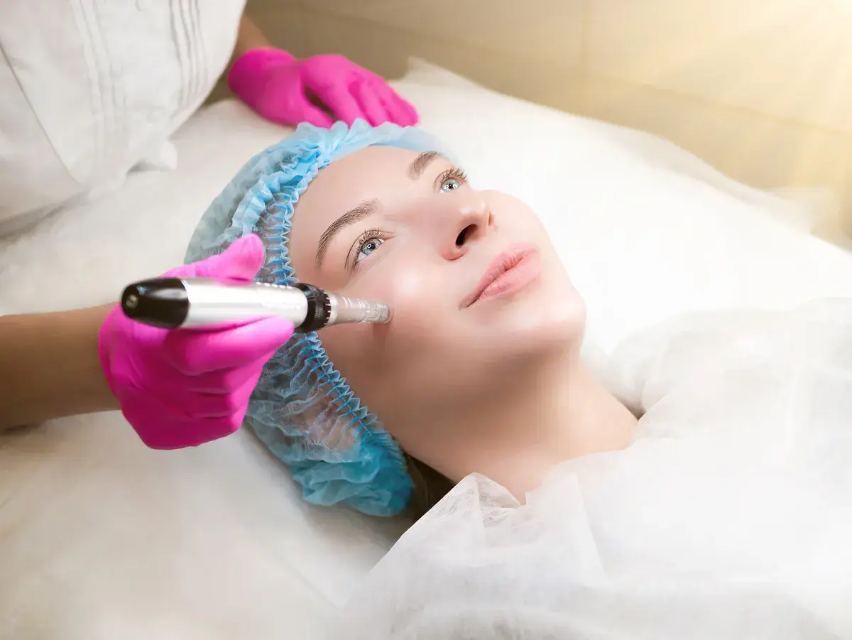 Microneedling and medical-grade skincare for melasma at a Miami Beach med spa, performed by a nurse practitioner